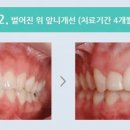 연세튼튼치과의원 네이버블로그