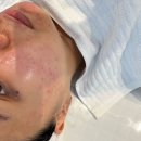 바비호호 | 신림역피부관리 바비로랑 여드름 수분관리 후기