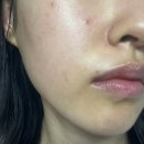 레드튠 | 턱 리프팅받으러 튠듀얼(튠레드&amp;튠라이너) 받고 온 직장인의 솔직후기 (효과, 추천 주기까지)