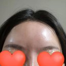 상무약국 | [내돈내산] 광주 상무지구 치평동 필러 보톡스 맛집...feat. 이마 필러+보톡스, 코필러 3주 후기 리터치)