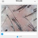 한올두피탈모