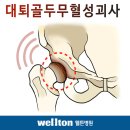 사타구니 통증 걸을 때 통증 있으시다구요? 대퇴골두무혈성괴사 의심해봐야합니다!!!! 이미지