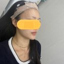 다산2 | 다산피부과 이마필러 2주차 후기 자연스러운 볼륨감 변화 기록