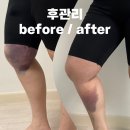 신사역 맥미걸 병원 허벅지 무한람스 3주차 (후관리, 홈케어)