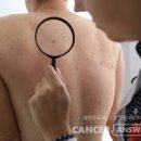 몸에 점 생기는 이유 갑자기 얼굴에 몸에 점이 생겨요 이미지