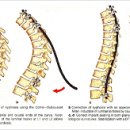 척추후만증이란? 이미지