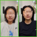 진솔케어 | 속초 피부관리 문제성 여드름 케어 진솔한 후기