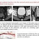 Ectopic ureteral insertion into the seminal vesicle associated with ipsilateral renal dysplasia 이미지