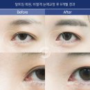 재건 | 앞트임재건후기를 볼 때 주의깊게 보아야 할 핵심 포인트는?