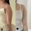 영등포 팔뚝지방추출주사 7주차 비교 변화후기 | 무한으로 몇 바틀 뽑았을까!?