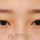 에이엠성형외과의원 네이버블로그