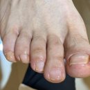 오레시피평택합정점 | 평택내성발톱 고민 엄마 발톱 건강 레푸스 평택역점에서 되찾았어요