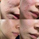 설산한의원 | 한의원 모낭염 치료후기 / 날치알모낭염 피부면역력 피부장벽 관리