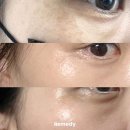 리메디뷰티아카데미룩서스플라즈마라이너노원지사