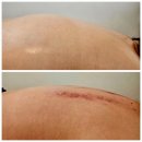 대구서재피부관리 라피움에스테틱 바디관리 받은 후기(근막케어 및 통증케어)