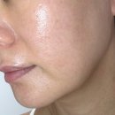 이온메디칼 | 강남 피부과에서 줄기세포 시술 후 이온자임관리까지 찐 후기!!