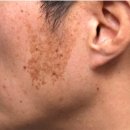 행신건강생활 | 행신역피부과 베커모반 색소치료 후기, 레이저 몇 번 받아야 효과 있을까?