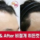 헤어라인 이미지