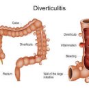 대장 게실염 증상 및 (복통 원인 하복부통증, 복부팽만감) 이미지
