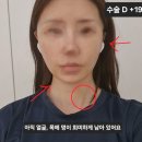 20 | 연조직 윤곽술 수술 후기 20일차/부작용