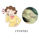 측두동맥염[Temporal arteritis]순환기질환 이미지