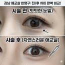 강남 애교살 반영구 추천 리메이드 강남점 솔직후기