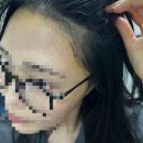 전병원 | 압구정역 헤어라인 비절개 모발이식 후기(수술 당일부터 14일차까지)