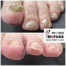 나도손톱 레푸스 개봉점 이미지