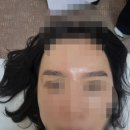 뷰티로그 - 춘천시 | 순천 눈썹전문 "로그뷰티" 잔흔제거 후기