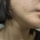 AC메디컬 | 성인 여드름 화장품 AC B6 스팟 솔루션 내돈내산 후기