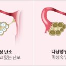 다낭성 난소 증후군 증상, 원인,치료 및 개선방법 이미지