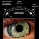 원추각막(keratoconus) 치료의 새로운 경향 이미지