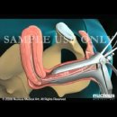 3D Medical Animation Endometrial Biopsy of the Uterus 이미지