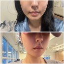 프롭테라피&밴드운동 | 붓기·소화불량에 효과? wbL 스왈 크리스탈 이혈테라피 귀침 주얼패치 사용 후기