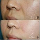 쁘띠성형, 남자친구도 모르게 예뻐지는 방법!! 쁘띠 필러성형~~!!!