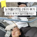 신항장외과의원 | 윗 눈꺼풀 처짐, 엑소젠 시술로 리프팅 받은 후기