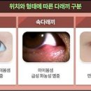 눈 다래끼 초기 증상 원인 째기 약 전염 이미지