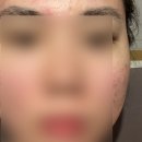 트로이온 | 동대문 압출 앤올리브에스테틱에서 트로이필 받고 온 솔직 후기