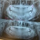 네모치과병원 | 매복사랑니 3개 한번에 이턱치과에서 발치한 후덜덜 후기