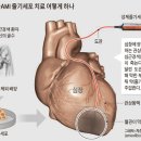 줄기세포 이용해 뇌경색 치료 - ‘꿈의 신약’상품화 첫 임상시험 이미지