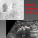 Renal Staghorn Calculus 신장 사슴뿔결석_2형당뇨병 환자(69/F) 이미지