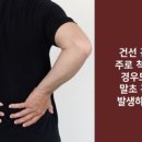 삶의 질을 악화시키는 ‘건선 관절염’ 이미지