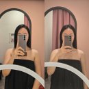 (주)지가디언 | 성남 팔뚝 지방추출주사 달스주사 비용 2주차 붓기
