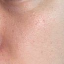 지오한의원 | [내돈내산] 창원편평사마귀 제거 솔직후기