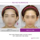 (주)모앤크리에이티브 | 모앤라인│여자 자연스러운 헤어라인 모발이식 첫 교정 3주차 경과 후기