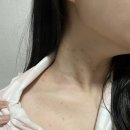 [광주] 북구 각화동 편평사마귀 제거 에이치앤에이치더바디 추천 후기