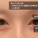 팝성형외과의원 | 팝 성형외과 쌍커풀 재수술 상담 후기 🩷