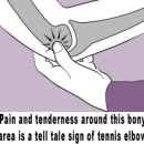 상완골 외측상과염(上腕骨 外側上顆炎, 테니스 엘보:Tennis elbow) 이미지