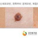 모반(피보험자가 보험가입당시 태아인 경우 화염상모반 등 선천성 비신생물성모반(Q82.5)은 보상합니다) 이미지