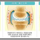 ◈퇴행성관절염 증상및 치료약◈ 이미지